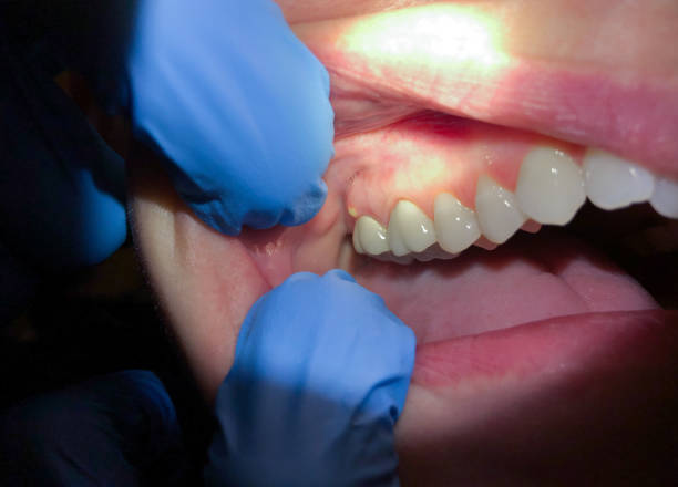 Best Chipped Tooth Repair Near Me  in Russellton, PA